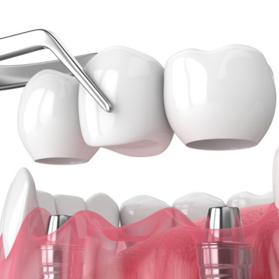 Close-up of an implant-supported dental bridge being removed for potential recementation, showing abutments and prosthetic teeth in a clinical setting.