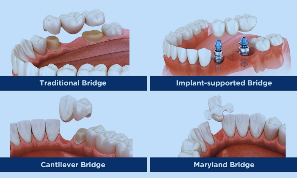 3-unit dental bridge diagram showing abutment teeth and artificial replacement tooth (pontic).