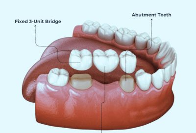 Dental bridge structure showing a fixed 3-unit bridge with abutment teeth and a replacement tooth filling the gap of a missing tooth.
