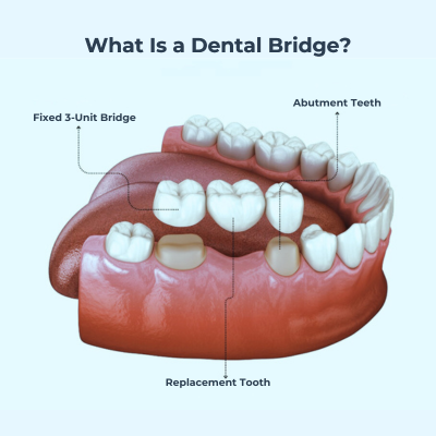 Dental bridge structure showing a fixed 3-unit bridge with abutment teeth and a replacement tooth filling the gap of a missing tooth.