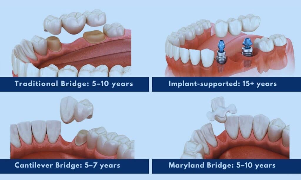 How Long Does A Bridge In Your Mouth Last