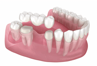 Visual of a dental bridge and question about its average lifespan.