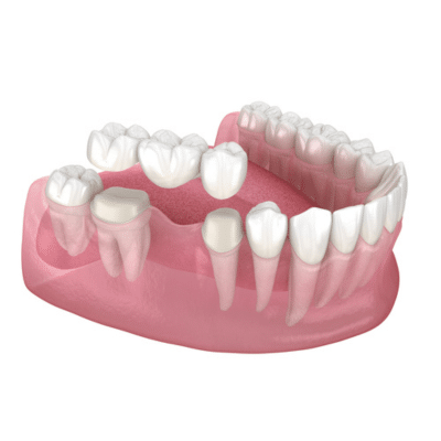 Visual of a dental bridge and question about its average lifespan.