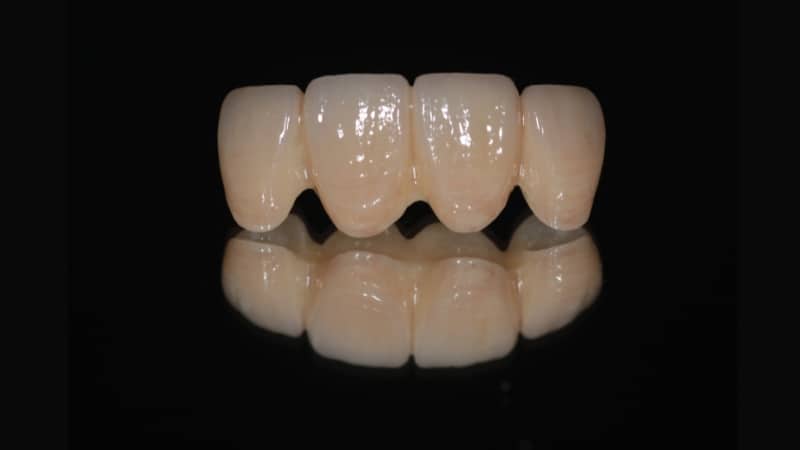 A close-up of a multi-unit all-porcelain dental bridge, showcasing its life-like aesthetics and translucency designed to mimic natural tooth enamel.