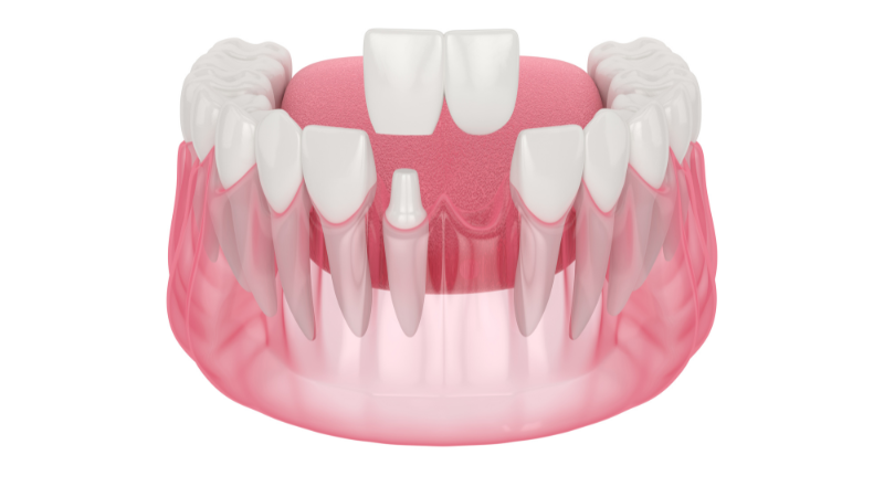Illustration of a cantilever dental bridge where an artificial tooth (pontic) is supported by a single dental crown on an adjacent tooth.