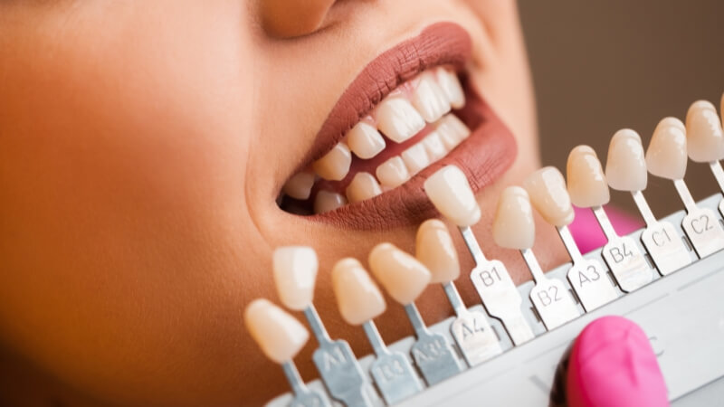 A dentist uses a professional shade guide to custom-match the color of a dental bridge to a patient's natural teeth, ensuring a seamless and natural look.