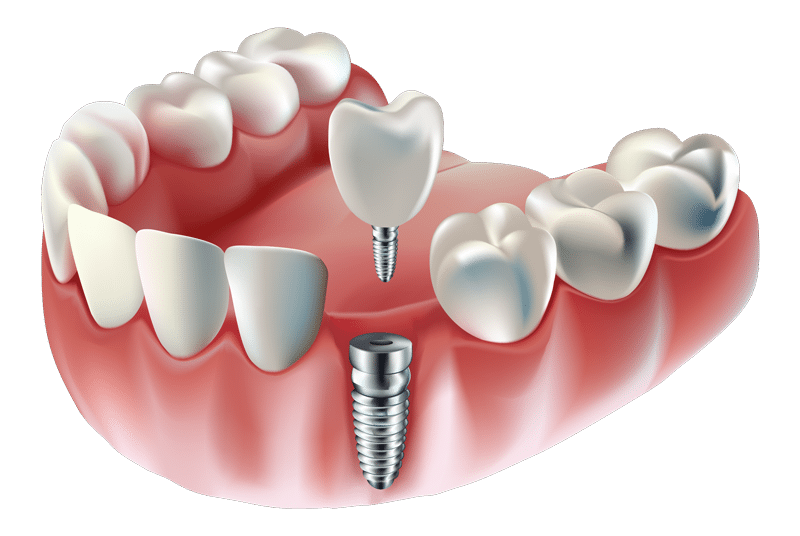 Illustration of a dental implant - Restoration Dental in Orange CA