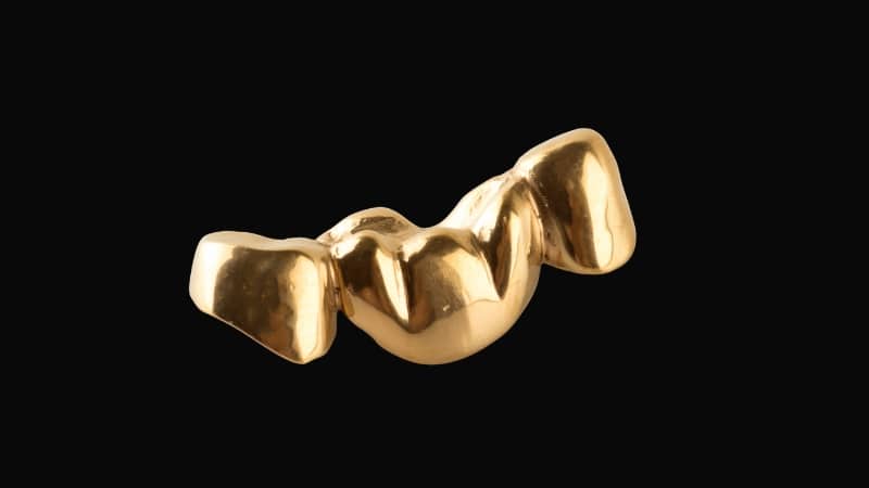 A multi-unit gold alloy dental bridge, valued for its outstanding strength and for being gentle on opposing teeth.