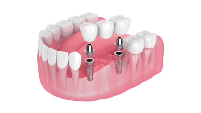 3D illustration showing an implant-supported bridge being placed onto two dental implants in the jawbone.
