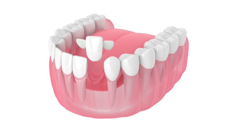 3D illustration of a Maryland bridge showing the pontic with two wings ready to be bonded to the back of adjacent teeth.
