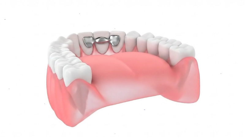 3D model view from behind of a Maryland bridge, showing the metal wings bonded to the back of the two adjacent abutment teeth.