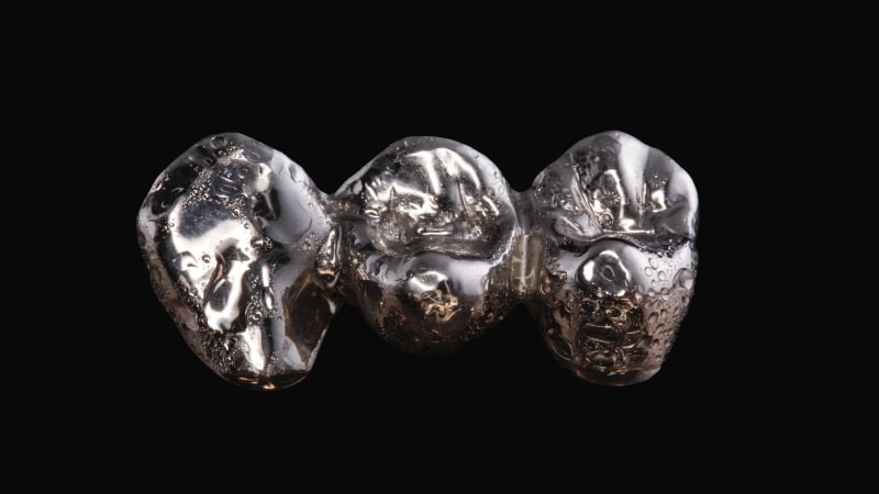 A close-up of a three-unit base metal alloy dental bridge, chosen for its high durability when replacing back molars.