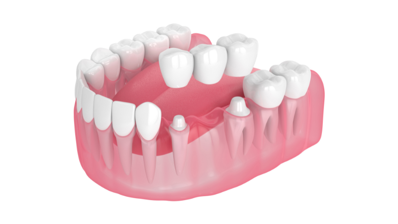 3D illustration of a traditional dental bridge being placed over two prepared abutment teeth to fill a gap.
