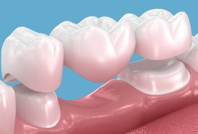 A 3D model answering the question of what a dental bridge looks like, showing a common three-unit traditional bridge.