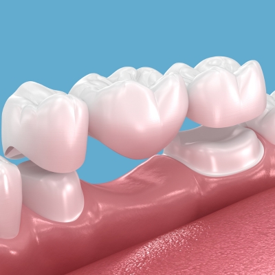 A 3D model answering the question of what a dental bridge looks like, showing a common three-unit traditional bridge.