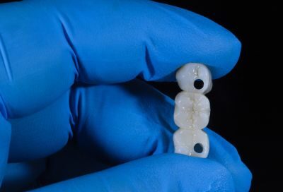 Underside of a porcelain dental bridge showing the hollow crowns where old cement must be removed.