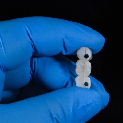 Underside of a porcelain dental bridge showing the hollow crowns where old cement must be removed.