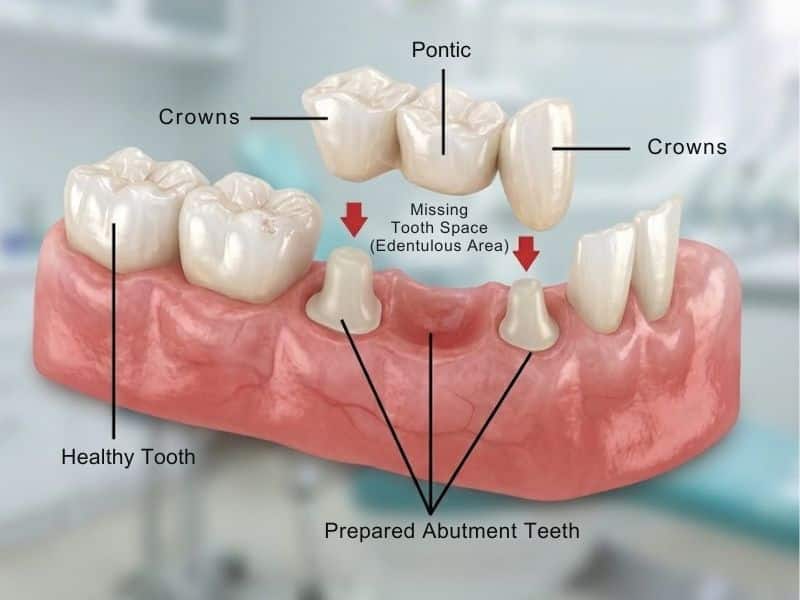 Diagram showing prepared abutment teeth and dental bridge structure for cleaning and temporary cementing at home.