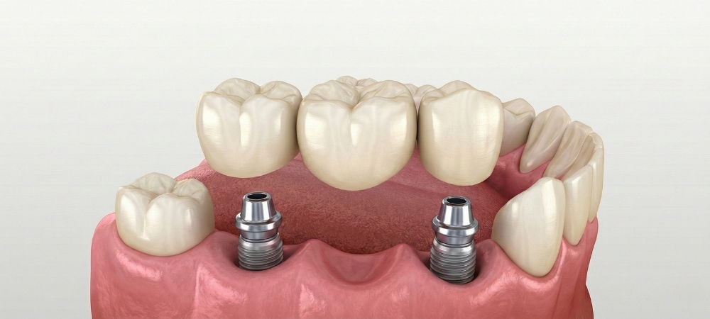 A customized fixed dental bridge being positioned to fill a gap of missing teeth, illustrating how prosthetic teeth restore smile completeness and prevent adjacent teeth from drifting.
