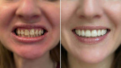 Before and after cosmetic dentistry treatment showing improved tooth color, alignment, and smile symmetry in Orange, CA