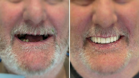 Before and after dental implant smile restoration showing replacement of missing teeth and improved tooth color in Orange, CA