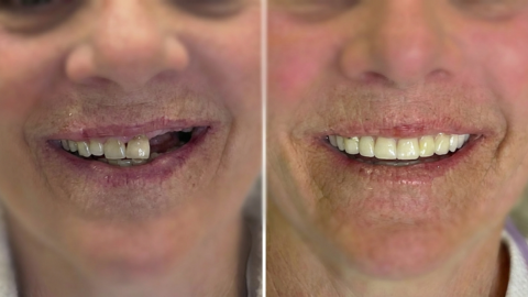 Before and after dental smile restoration showing improved tooth alignment and esthetics at a dental office in Orange, CA