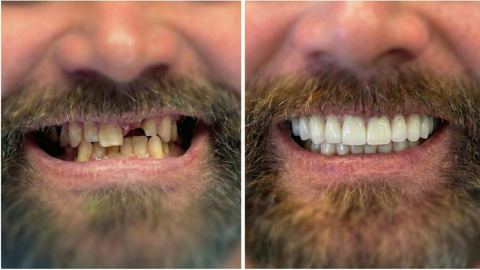 Before and after full mouth dental restoration showing improved tooth alignment, color, and symmetry in Orange, CA