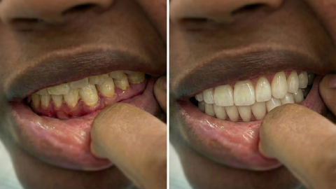 Before and after periodontal treatment showing removal of plaque buildup and improved gum health in Orange, CA
