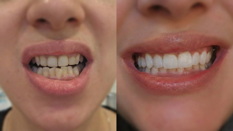Before and after porcelain veneers treatment showing improved tooth color, alignment, and smile symmetry in Orange, CA