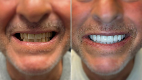 Before and after cosmetic dental smile restoration showing improved tooth color, alignment, and overall symmetry in Orange, CA