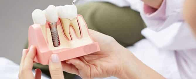 dental implant parts