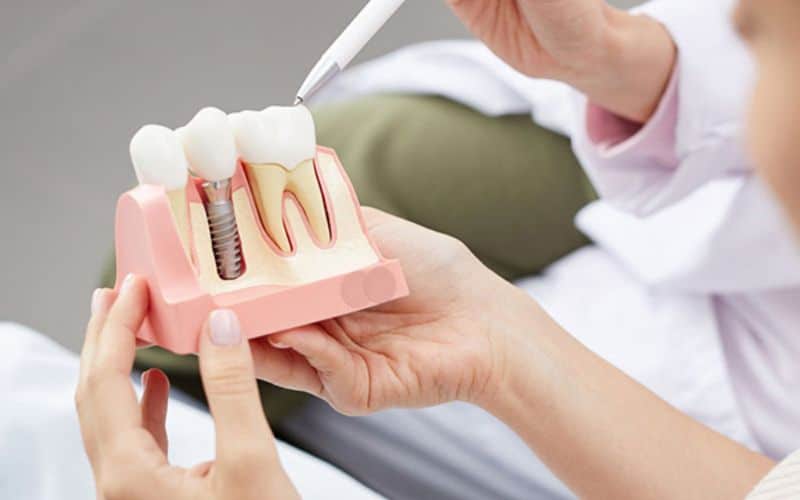 dental implant parts