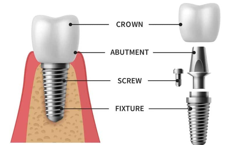 A dental implant is a 3 part integrated system: Fixture → Abutment → Crown.