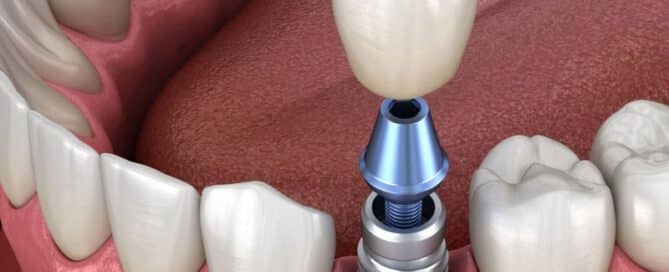 implant abutment