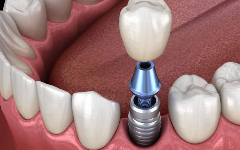 implant abutment