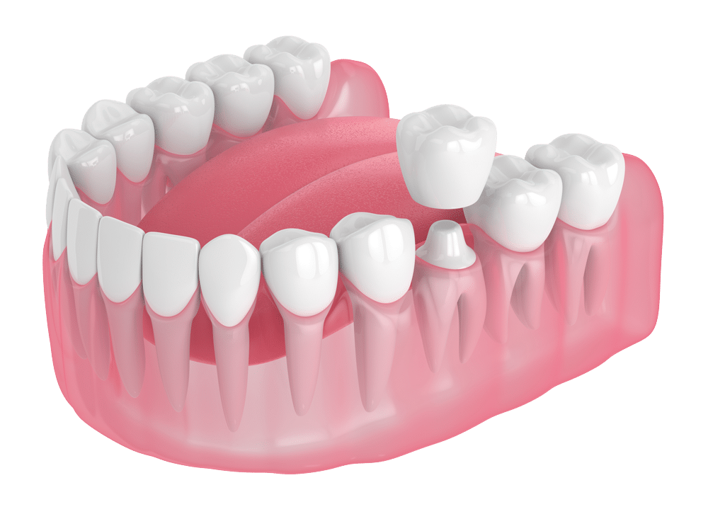 Illustration of a dental crown - Restoration Dental in Orange CA