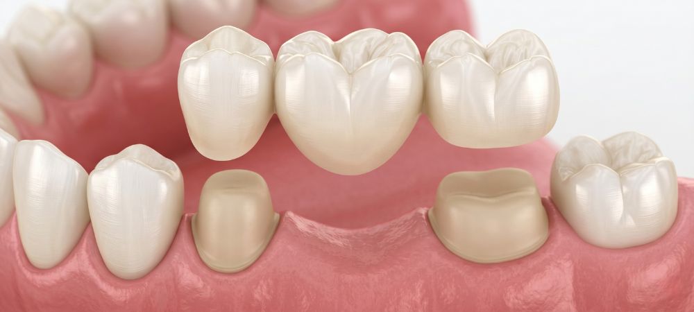 3D illustration of a dental bridge being placed over prepared teeth to fill a gap, highlighting our expert Restorative Dentistry in Orange CA