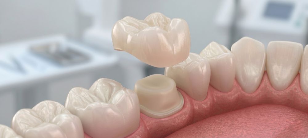 Close-up 3D illustration of a dental crown fitting over a damaged tooth to restore its function and natural appearance.