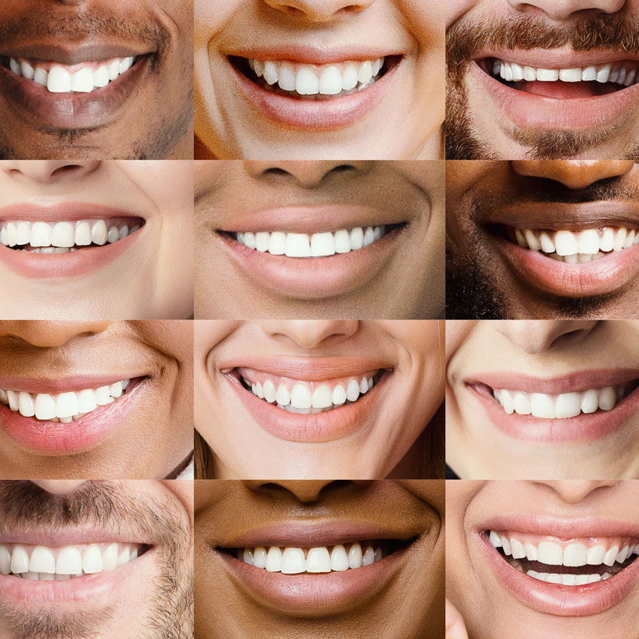 Dental Veneers Orange CA - Dr Pham is a dental veneer specialist in Orange County CA