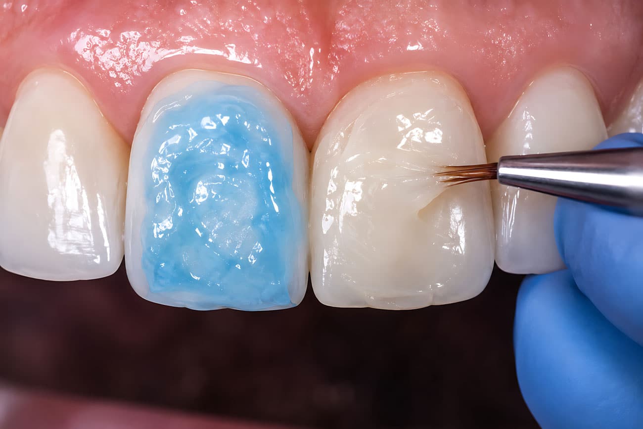Dental Bonding and Cosmetic Dentistry in Orange CA by Restoration Dental OC