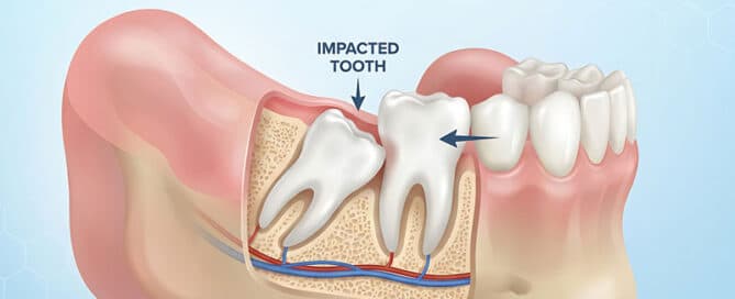 Impacted Wisdom Teeth