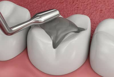 When a Tooth Filling Falls Out