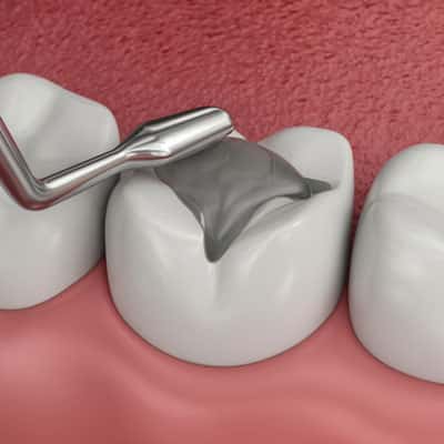 Restoration Dental: When a Tooth Filling Falls Out: What To Do and When To See a Dentist